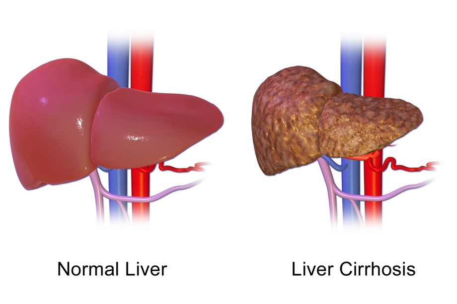 Cirrhosis: Permanent scarring of liver | Agency-Wire